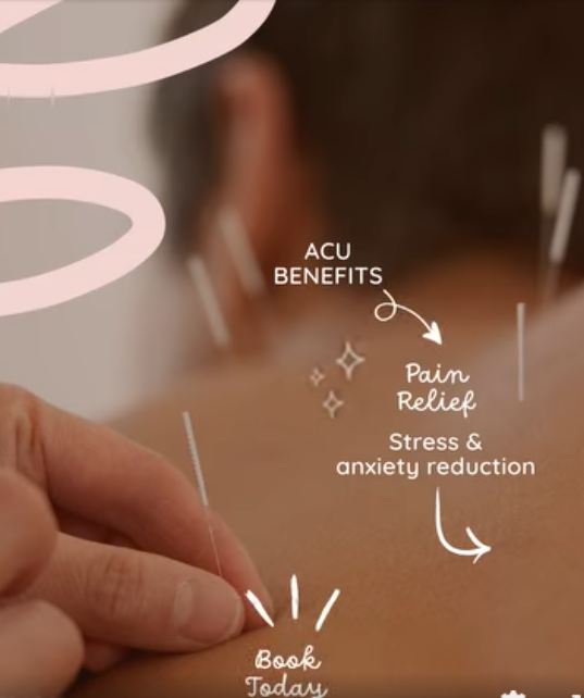 Acupuncture for Pain and Stress Relief