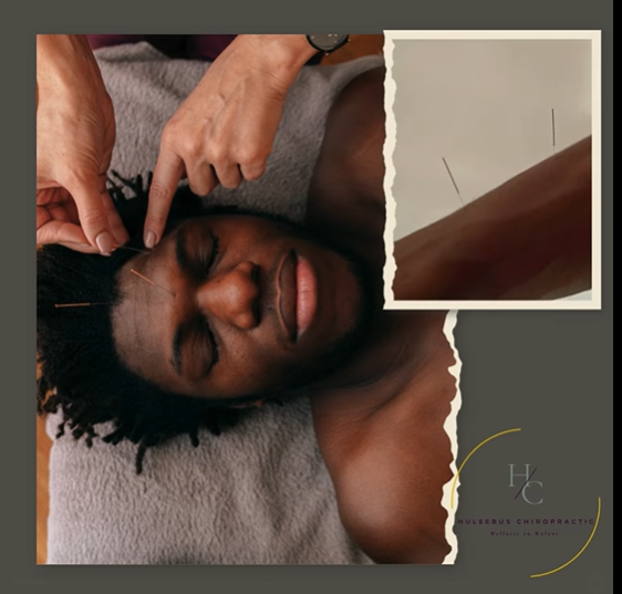 Acupuncture for headaches